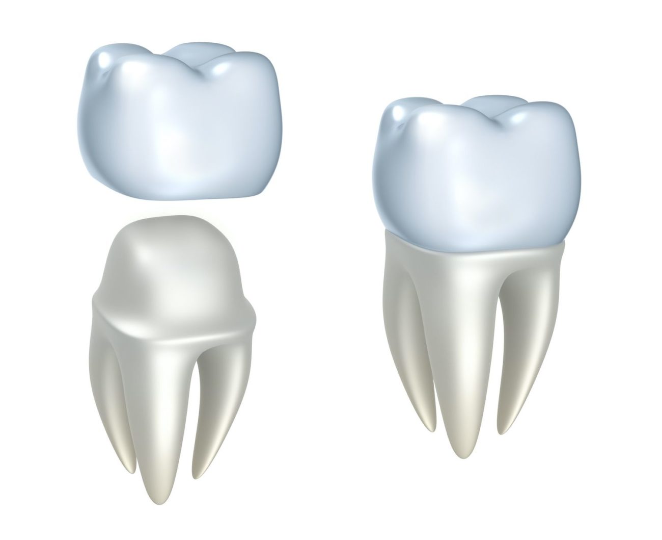 Steps to the Dental Crown Procedure - Dentist in Marrero, LA